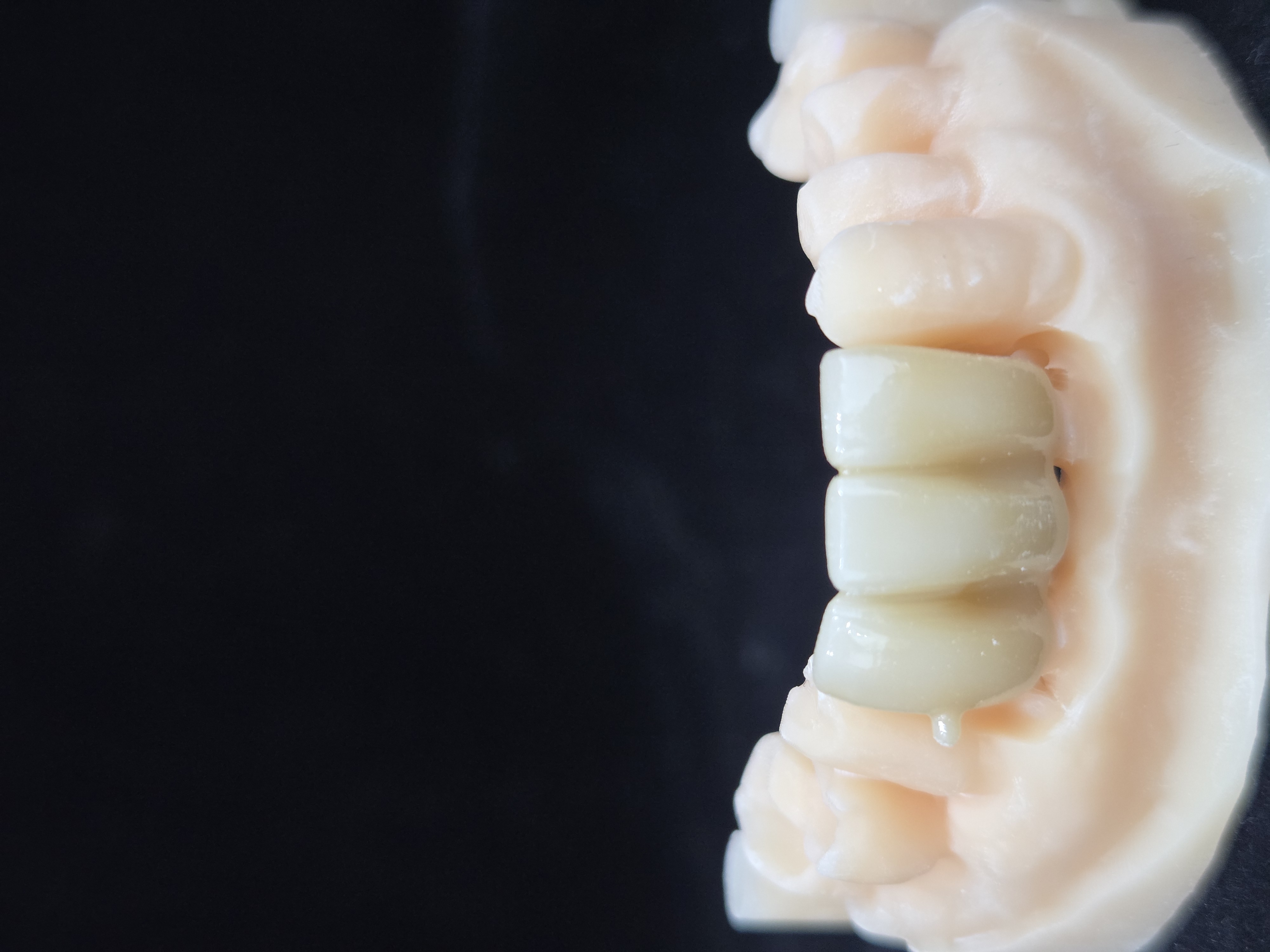 지르코니아 크라운 측면